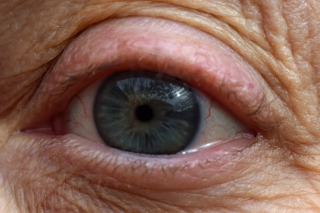 Infection aux yeux, que faire pour s'en débarrasser ?